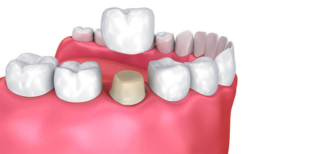 Dental Crown Services - Manotick