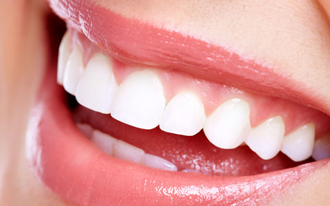 Dental restorations
